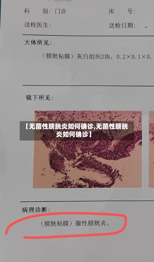 【无菌性膀胱炎如何确诊,无菌性膀胱炎如何确诊】