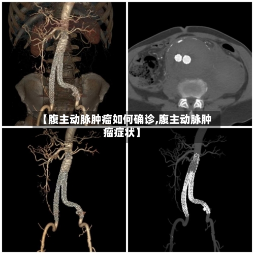 【腹主动脉肿瘤如何确诊,腹主动脉肿瘤症状】