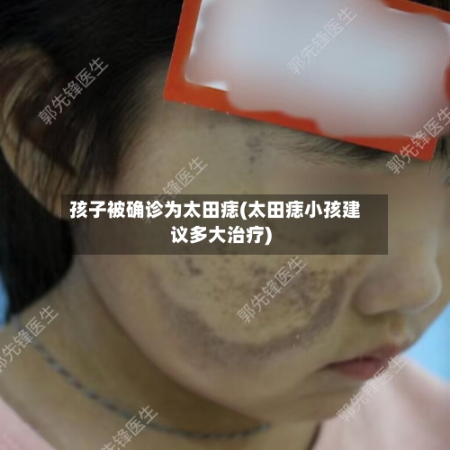 孩子被确诊为太田痣(太田痣小孩建议多大治疗)